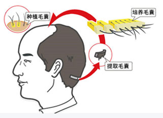 公立医院的植发选择，如何找到最适合你的脱发治疗机构？