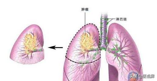 肺腺癌中期症状详解